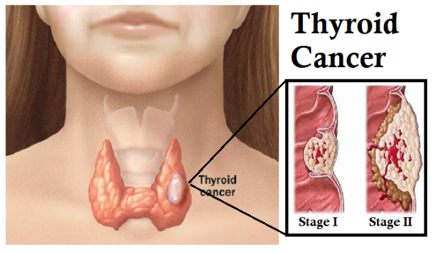 Thyroid-Cancer-Symptoms